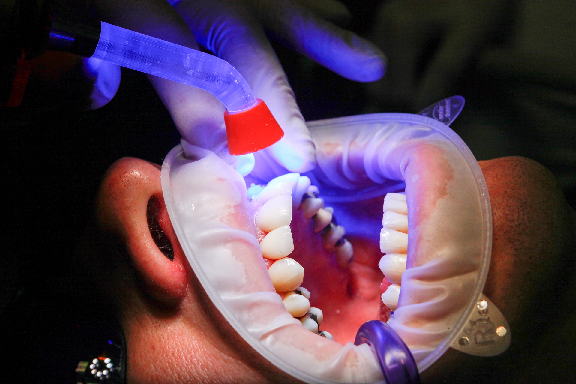 All you need to know about teeth whitening